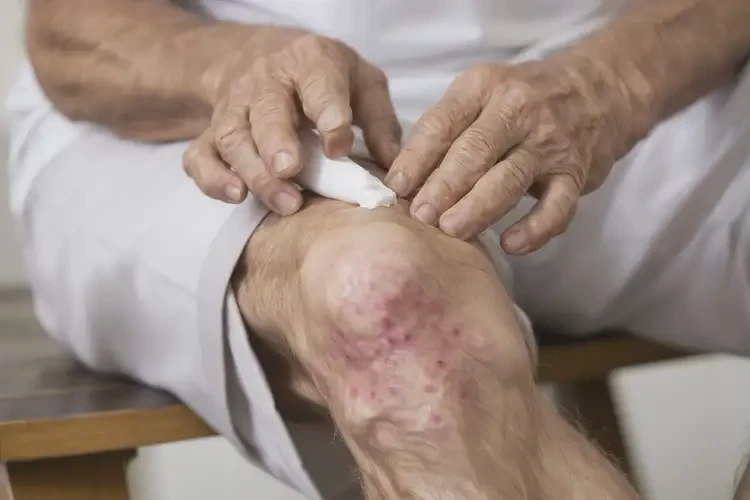 老年人大腿上有濕疹不管它會自己痊愈嗎(圖2)