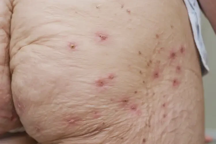 老年人屁股經(jīng)常起濕疹不管它會(huì)自己自愈嗎(圖4)