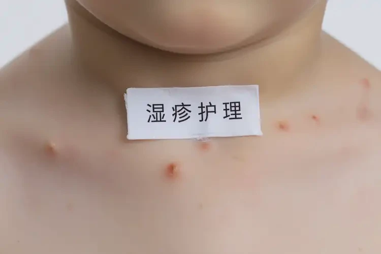 少兒脖子上偶爾起濕疹能徹底自愈嗎(圖4)