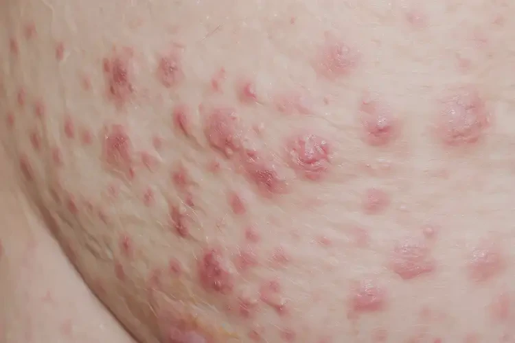 女性肛周出濕疹可不可以徹底自愈(圖3)