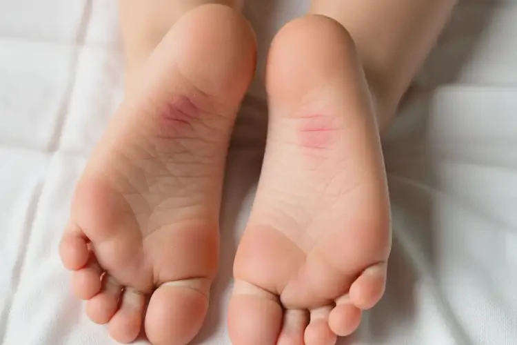 少兒腳上出現(xiàn)濕疹可不可以根治(圖1)