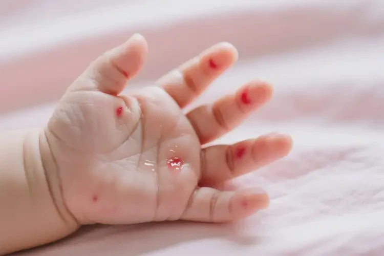 嬰兒身上長(zhǎng)濕疹不管它會(huì)自己好嗎(圖2)