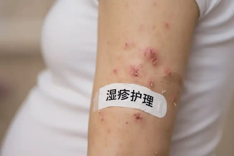 哺乳期媽媽手臂上出濕疹能不能根治(圖4)