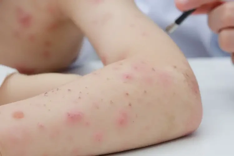 孩子手臂偶爾起濕疹可不可以根治(圖3)