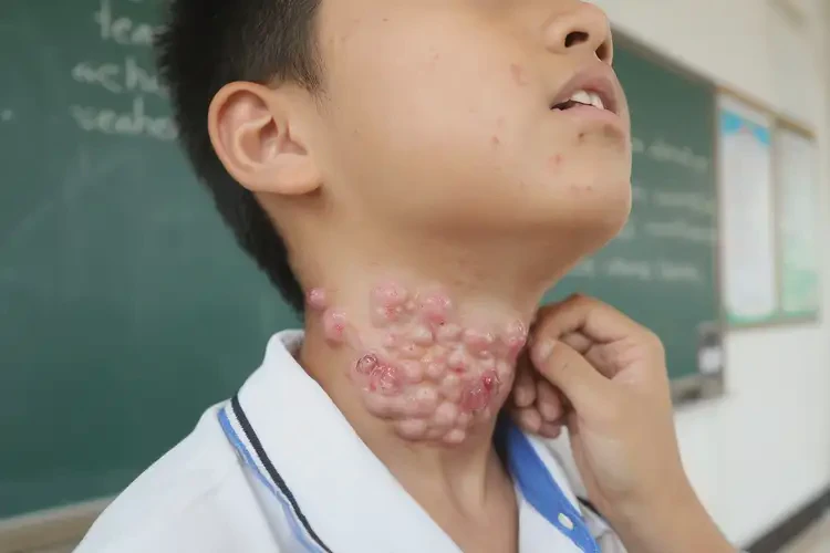 中學(xué)生脖子上起濕疹可不可以徹底自愈(圖4)