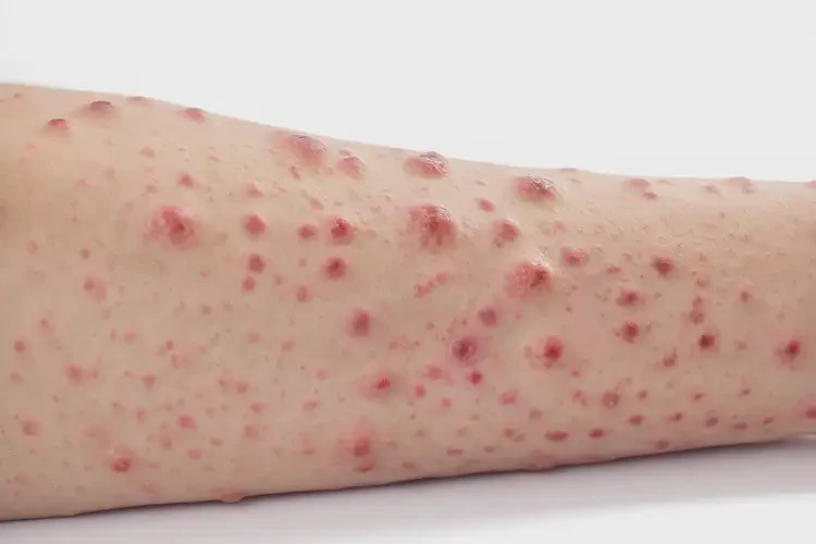 男人手臂偶爾長濕疹不管它會自己自愈嗎(圖3)