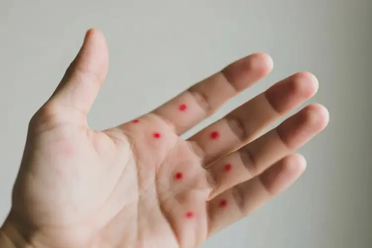 男生手上偶爾起濕疹不管它會(huì)自己好嗎(圖4)