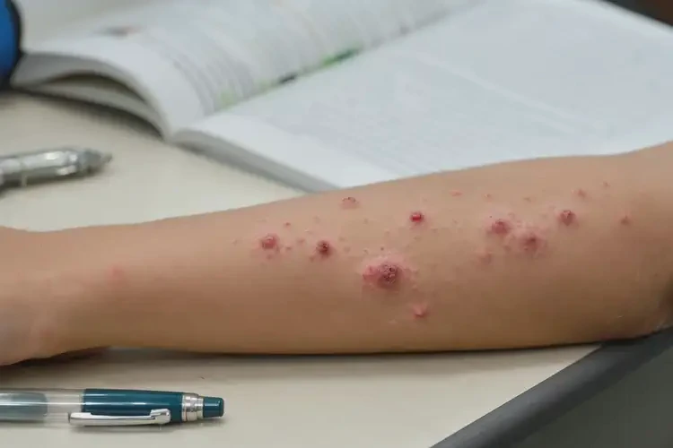 中学生屁股上出湿疹不管它会自己痊愈吗(图4)