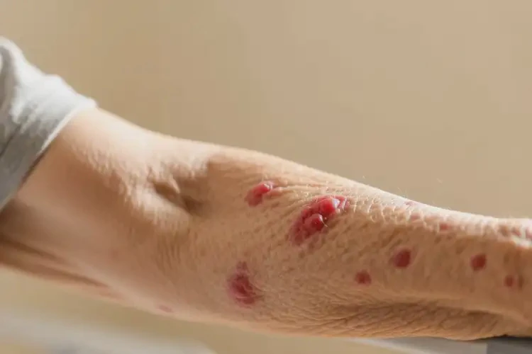 老年人身上經(jīng)常起濕疹不管它會自己自愈嗎(圖4)