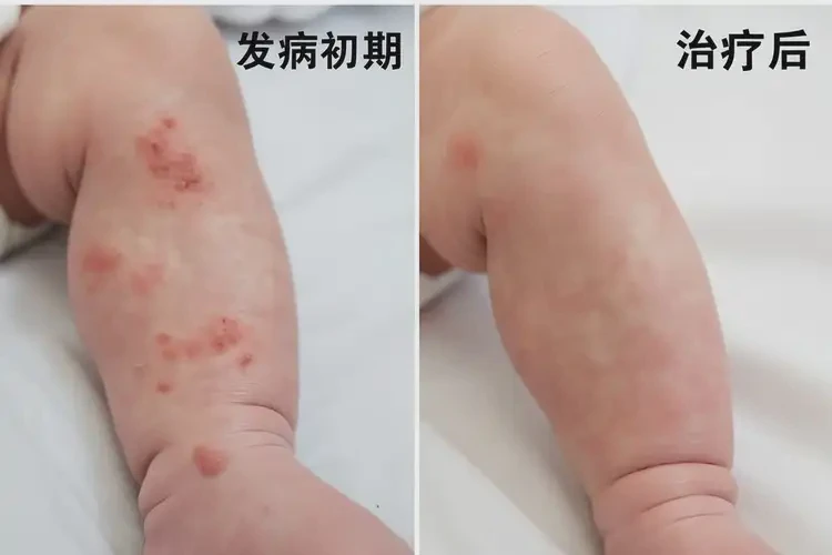 新生兒小腿經(jīng)常起濕疹可不可以徹底自愈(圖1)