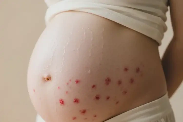 產(chǎn)婦肚子容易起濕疹不管它會(huì)自己好嗎(圖2)