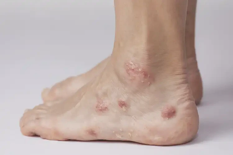 女生腳上出濕疹不管它會(huì)自己好嗎(圖4)