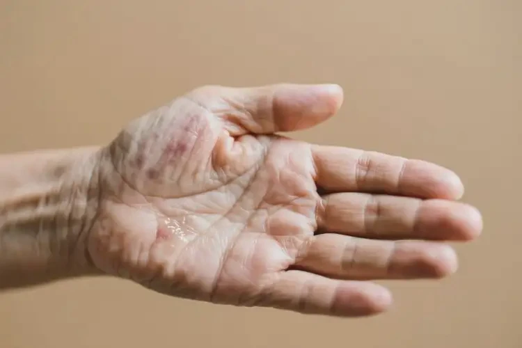 老人手上出濕疹能夠徹底治愈嗎(圖1)