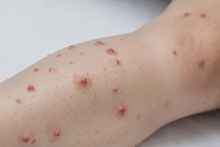 兒童小腿起濕疹可不可以徹底自愈(圖2)