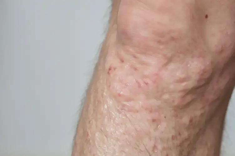 老年人小腿上偶尔起湿疹能够彻底治愈吗(图4)