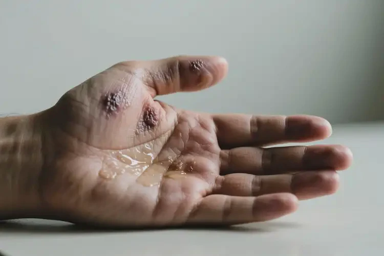 男性手上起濕疹能靠自己自愈嗎(圖2)