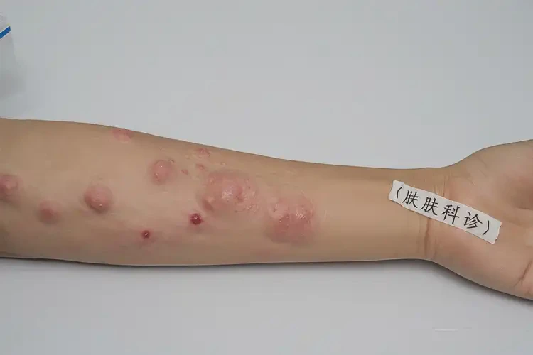 大學(xué)生手臂上有濕疹可以徹底自愈嗎(圖4)