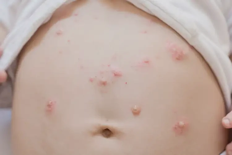 寶寶肚子經(jīng)常起濕疹可不可以根治(圖4)