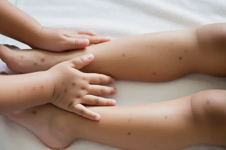 孩子四肢容易起濕疹可不可以根治(圖1)