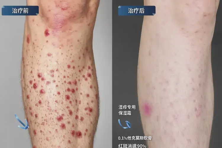 青年人小腿上經(jīng)常起濕疹不管它會(huì)自己痊愈嗎(圖2)