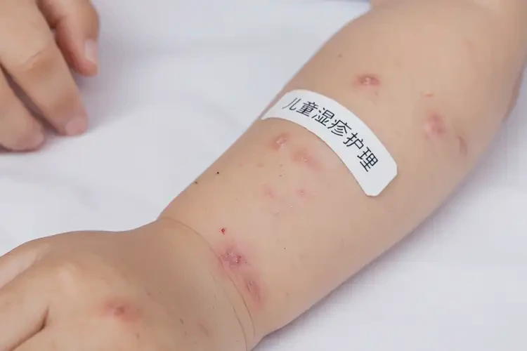 孩子全身偶爾長(zhǎng)濕疹不管它會(huì)自己自愈嗎(圖4)