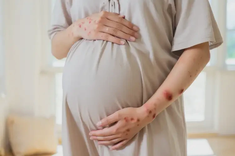 孕婦四肢偶爾起濕疹不管它會(huì)自己好嗎(圖4)