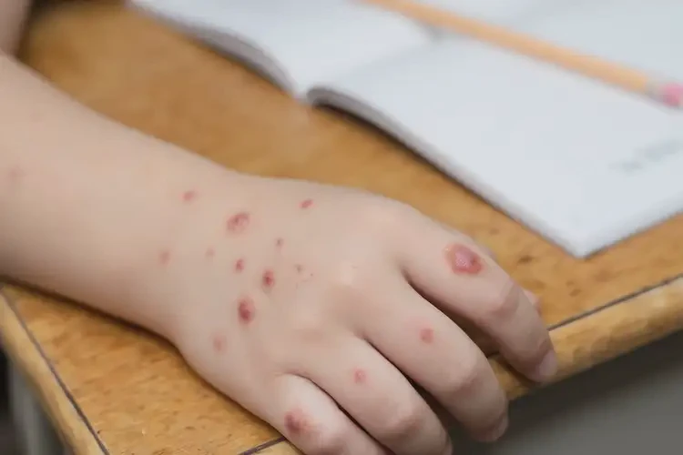 小學生手上出濕疹不管它會自己痊愈嗎(圖4)