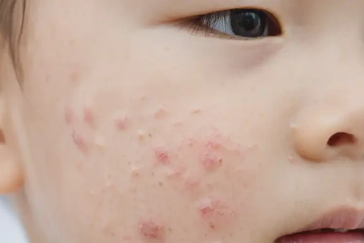 少兒面部容易起濕疹能靠自己自愈嗎(圖4)