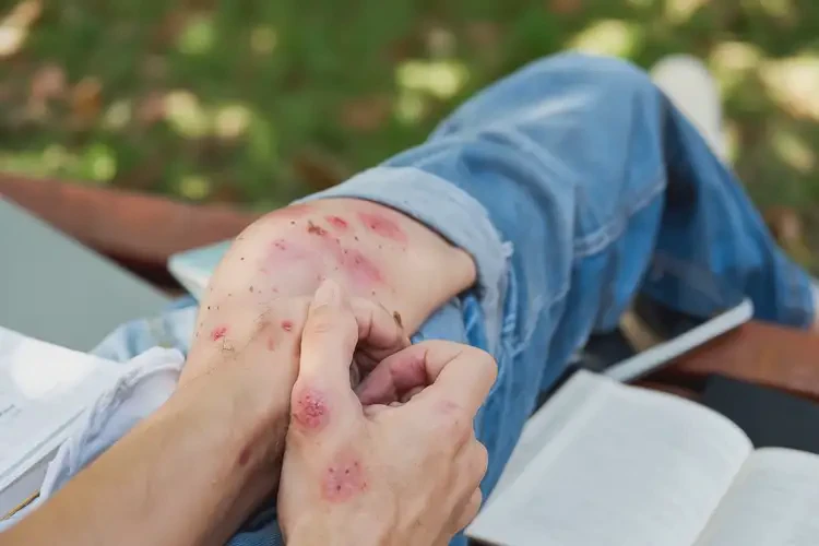 大學(xué)生小腿上偶爾起濕疹能不能徹底自愈(圖4)