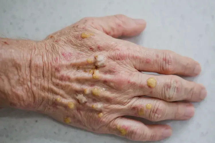 老年人手上偶爾長(zhǎng)濕疹不管它會(huì)自己好嗎(圖3)