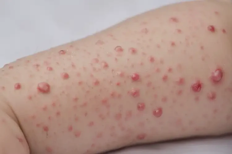 孩子屁股上經(jīng)常起濕疹可不可以根治(圖4)