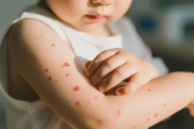 少儿手臂上偶尔起湿疹能靠自己自愈吗(图4)