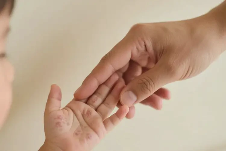 小兒手上容易長濕疹不管它會(huì)自己痊愈嗎(圖3)