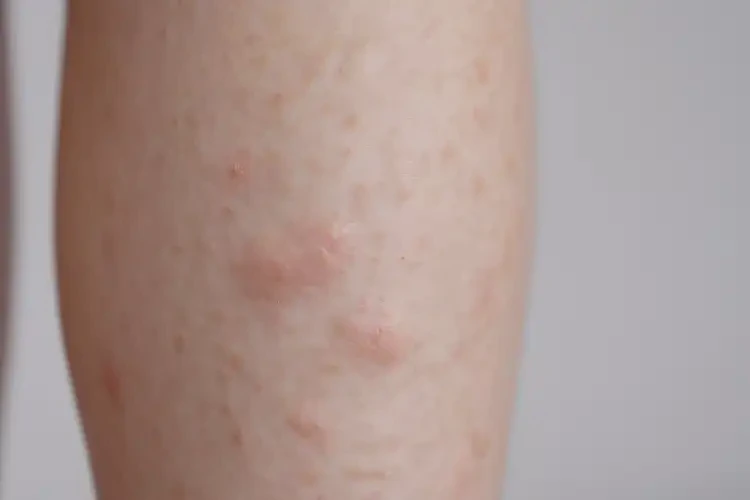 少兒小腿上偶爾起濕疹能靠自己自愈嗎(圖4)