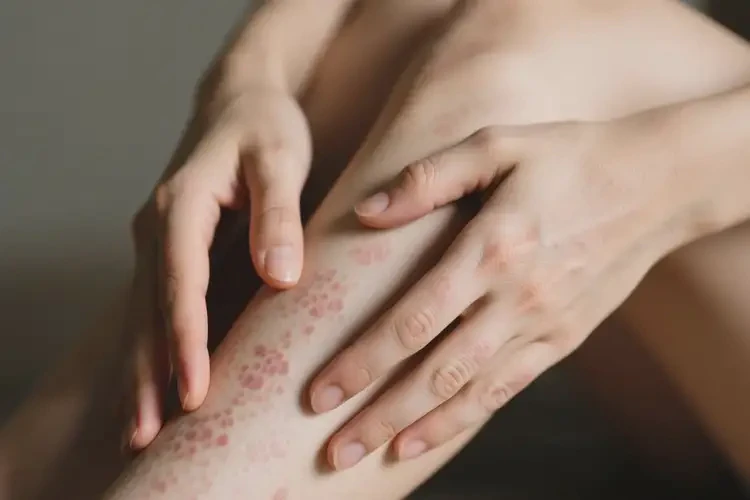 女性四肢起濕疹不管它會自己自愈嗎(圖1)