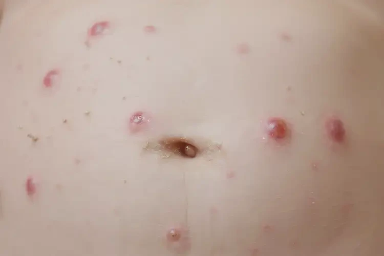 嬰兒肚子上起濕疹能徹底自愈嗎(圖4)