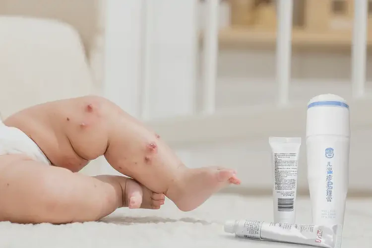 寶寶小腿上長濕疹能靠自己自愈嗎(圖4)