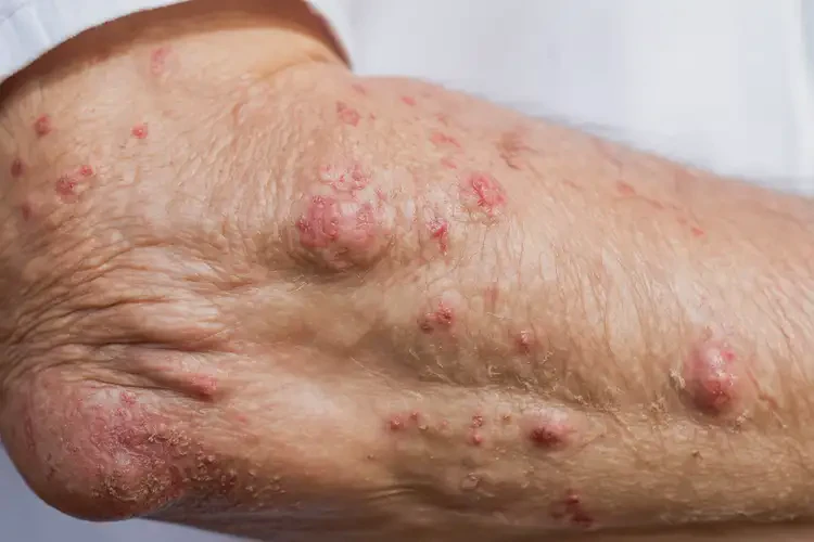 老人全身經(jīng)常長(zhǎng)濕疹能靠自己自愈嗎(圖4)