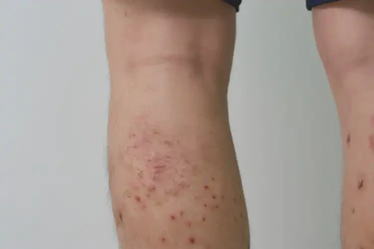 青年人小腿上經(jīng)常起濕疹不管它會(huì)自己痊愈嗎(圖3)