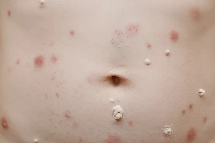 兒童肚子出現(xiàn)濕疹可不可以根治(圖4)