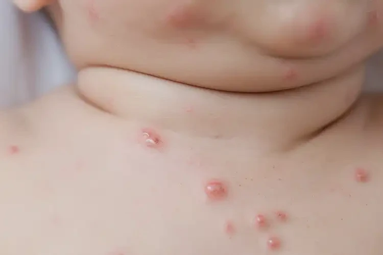 婴儿脖子上出现湿疹可不可以根治(图4)