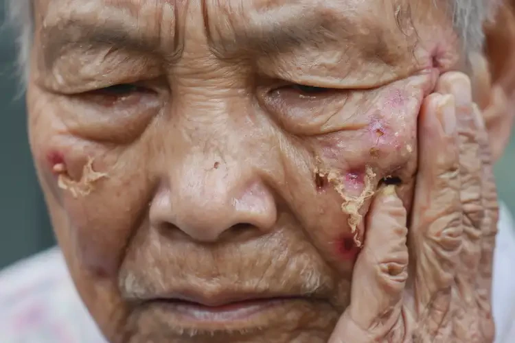 高齡老人臉上有濕疹不管它會(huì)自己痊愈嗎(圖4)