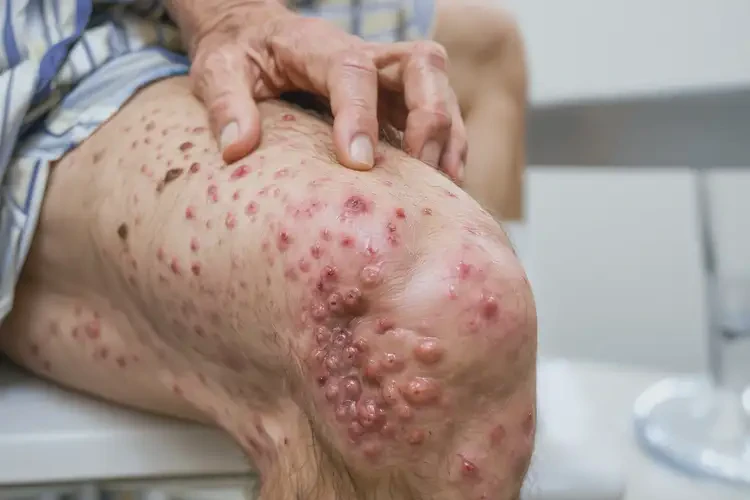 老年人肛周有濕疹可不可以徹底自愈(圖4)