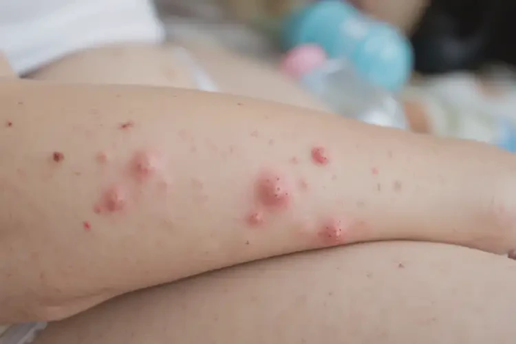 哺乳期媽媽手臂上經(jīng)常起濕疹能不能徹底自愈(圖4)