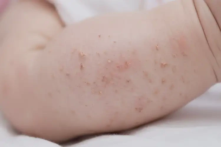 寶寶小腿容易長(zhǎng)濕疹不管它會(huì)自己自愈嗎(圖4)