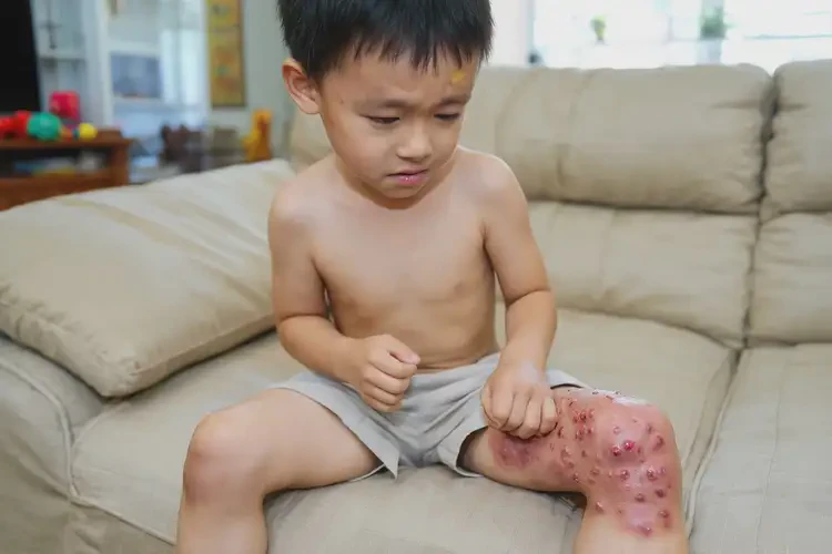 小孩大腿出濕疹不管它會自己痊愈嗎(圖3)