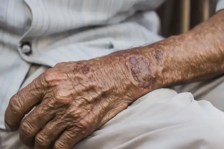 老年人全身偶尔起湿疹不管它会自己痊愈吗(图3)