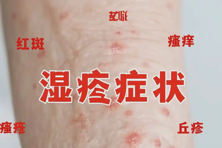 老人四肢經(jīng)常長(zhǎng)濕疹可不可以根治(圖4)
