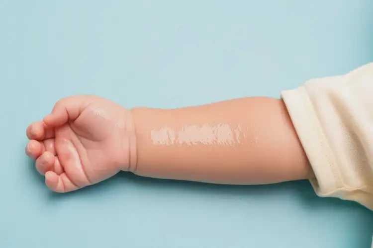 嬰兒手臂上偶爾長(zhǎng)濕疹不管它會(huì)自己痊愈嗎(圖2)