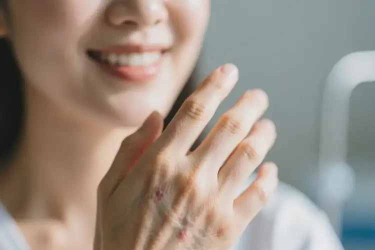 女性身上有湿疹能够彻底治愈吗(图4)